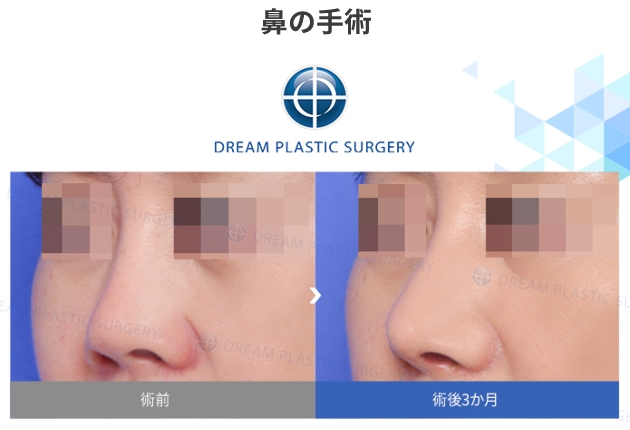 鼻の手術の症例